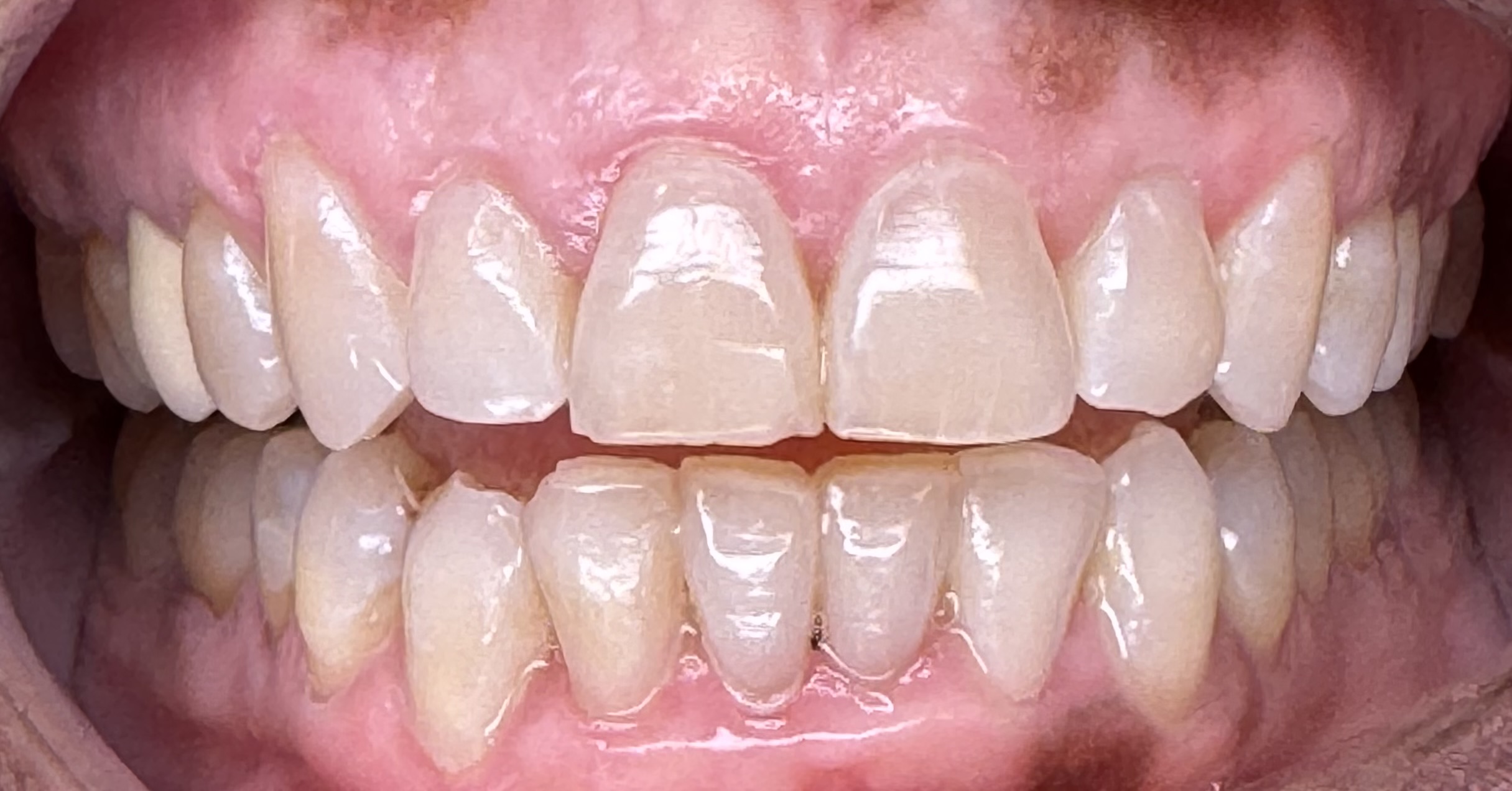 Aligners, front view — after treatment
