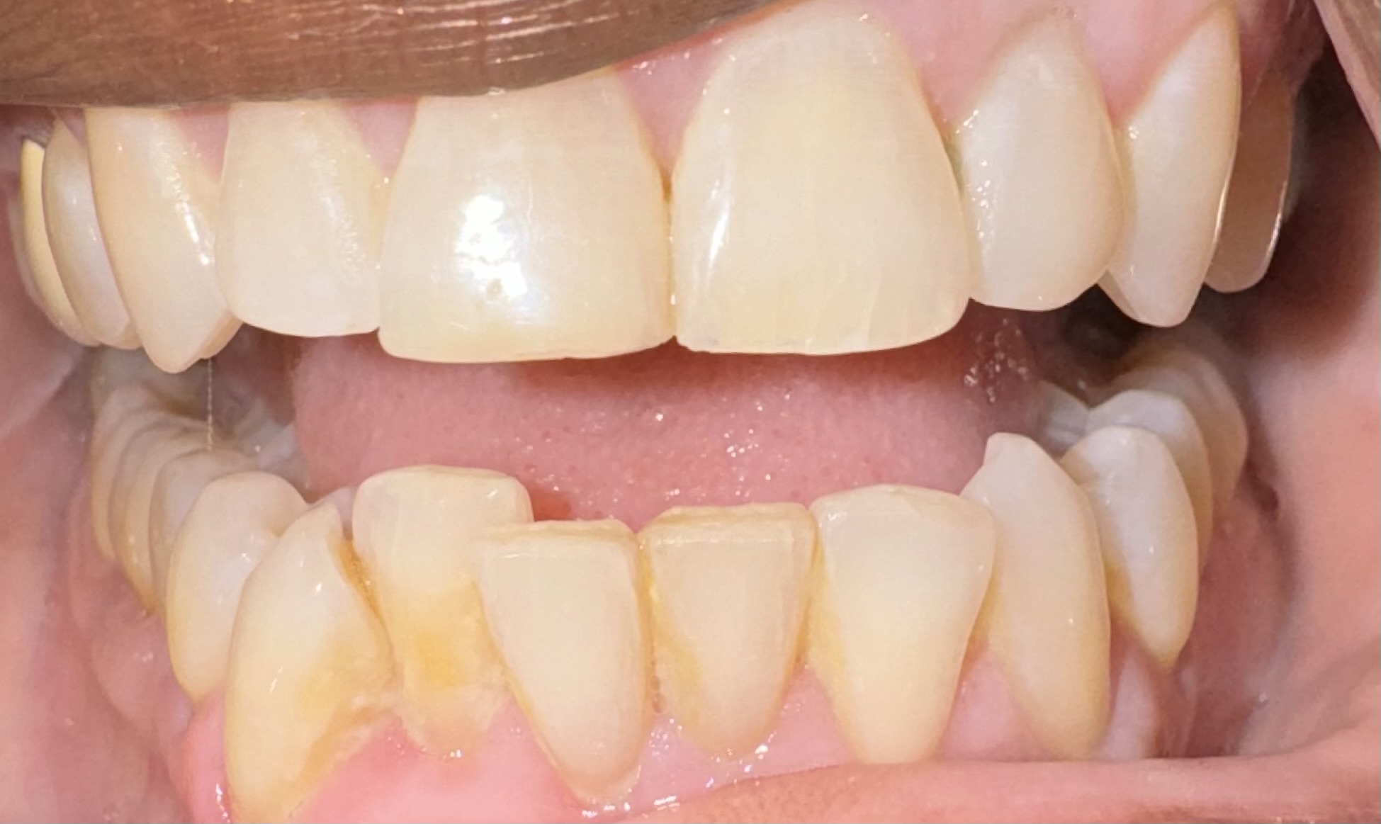 Aligners, front view — before treatment