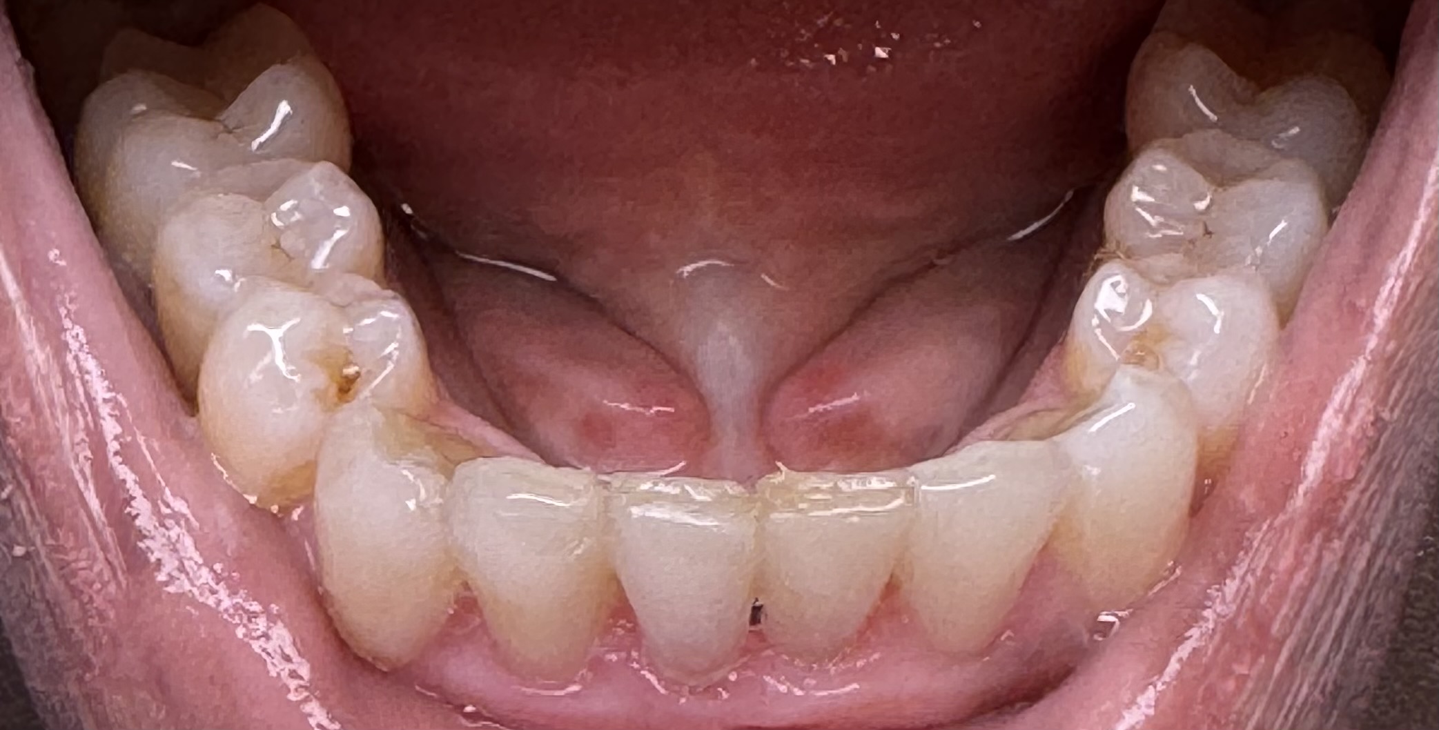 Aligners, lower teeth view — after treatment