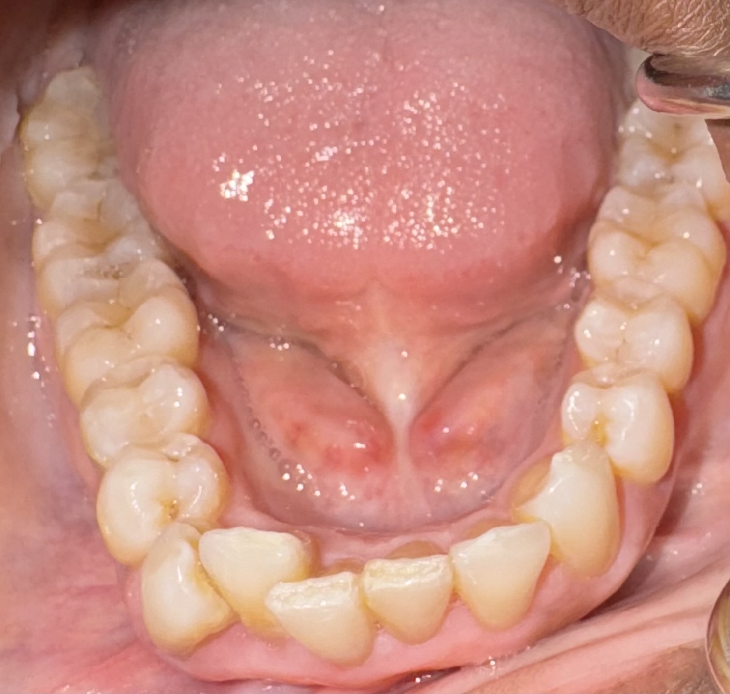 Aligners, lower teeth view — before treatment