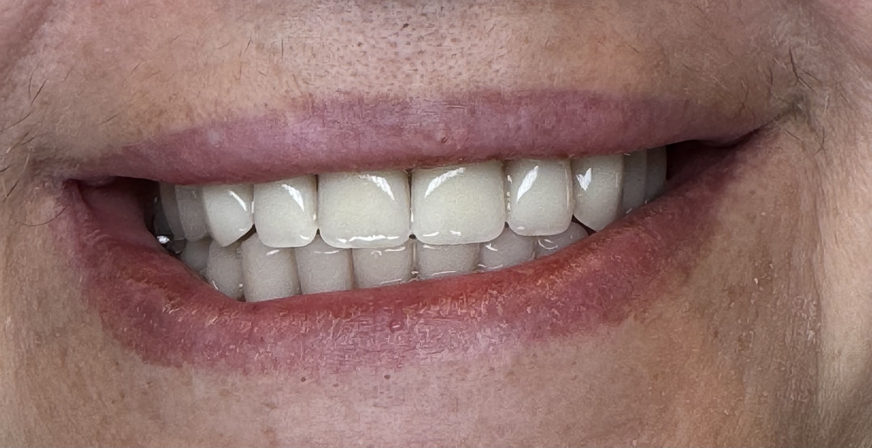 Dentures, case 1 — after treatment