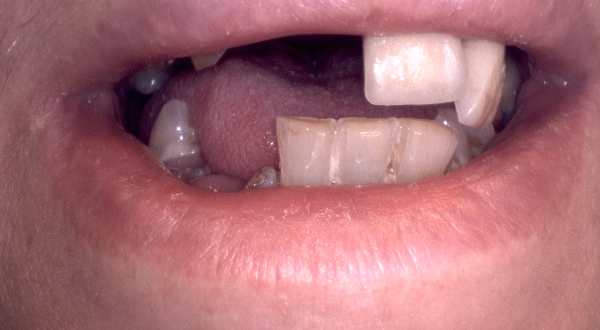 Dentures, case 1 — before treatment