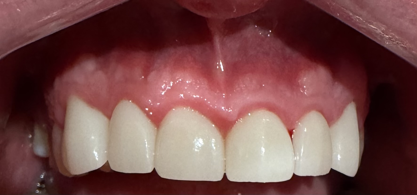 Upper Anterior Crowns, upper front teeth — after treatment