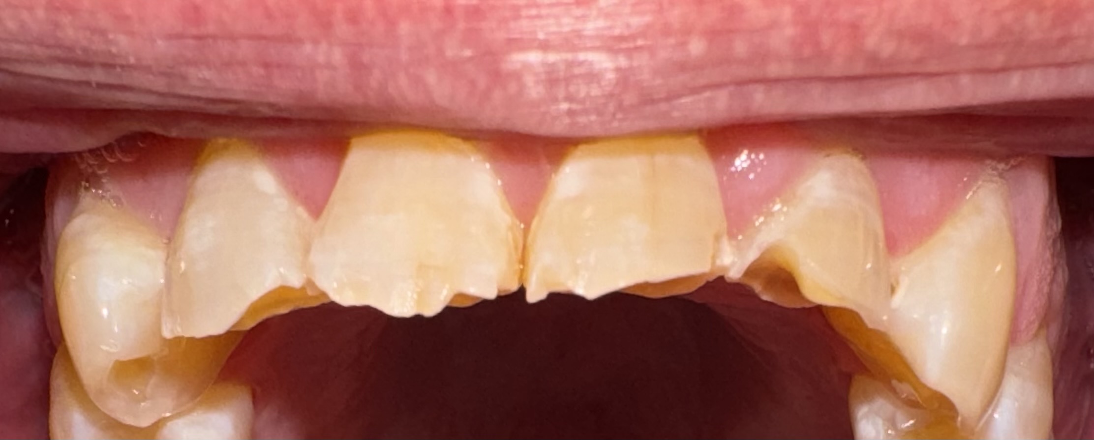 Upper Anterior Crowns, upper front teeth — before treatment