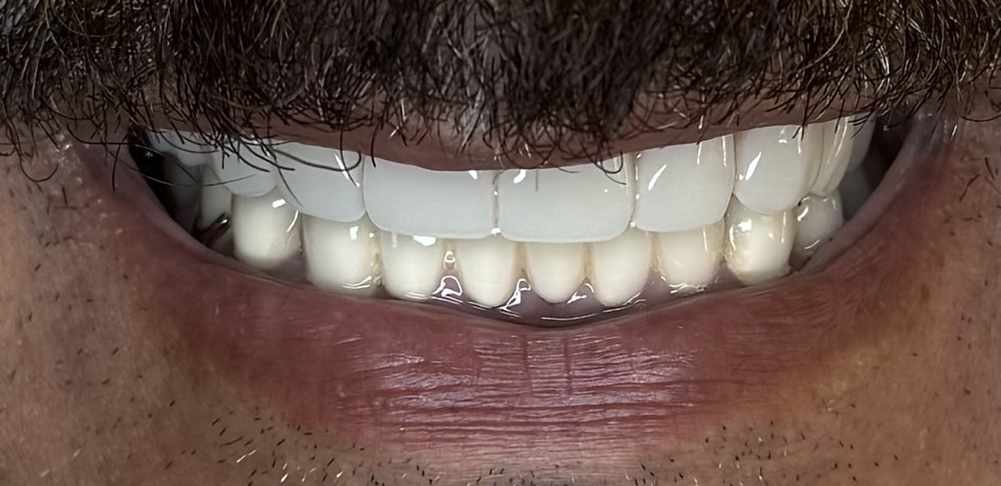 Upper Dentures with Lower Crowns, case 1 — after treatment