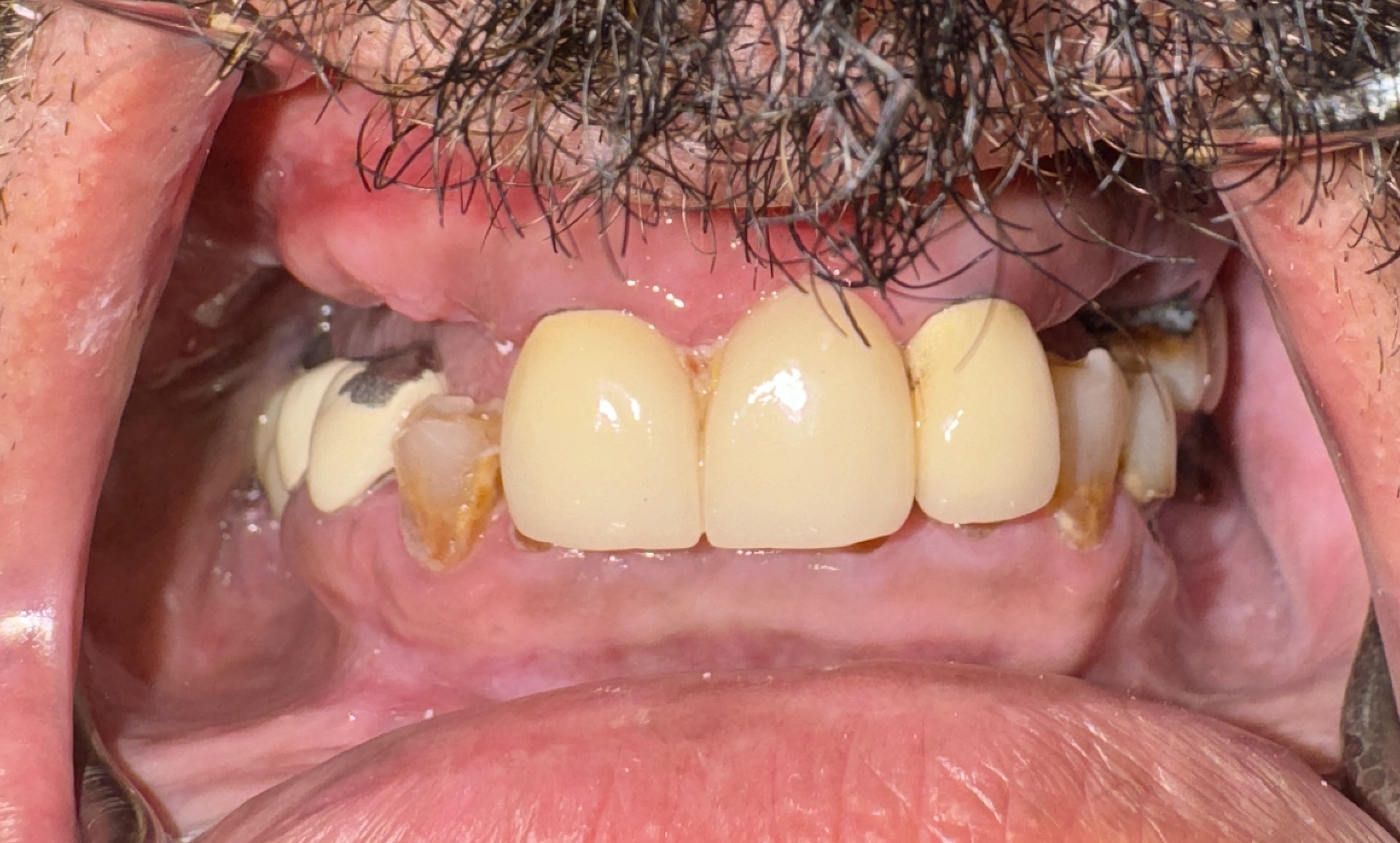 Upper Dentures with Lower Crowns, case 1 — before treatment
