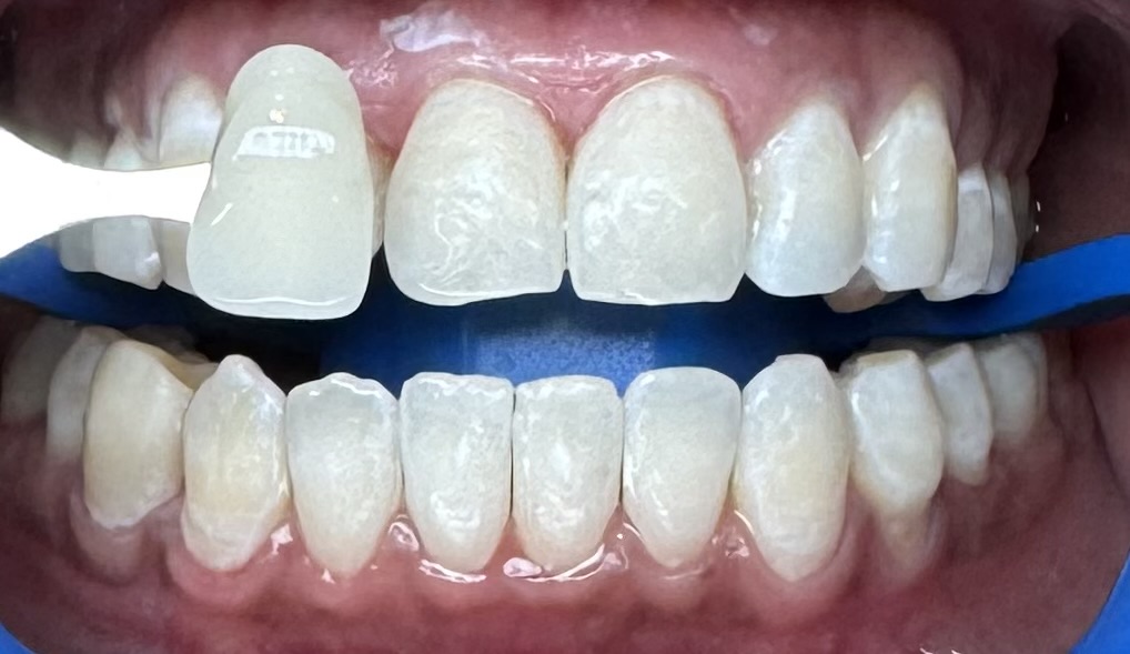 Teeth Whitening, case 1 — after treatment