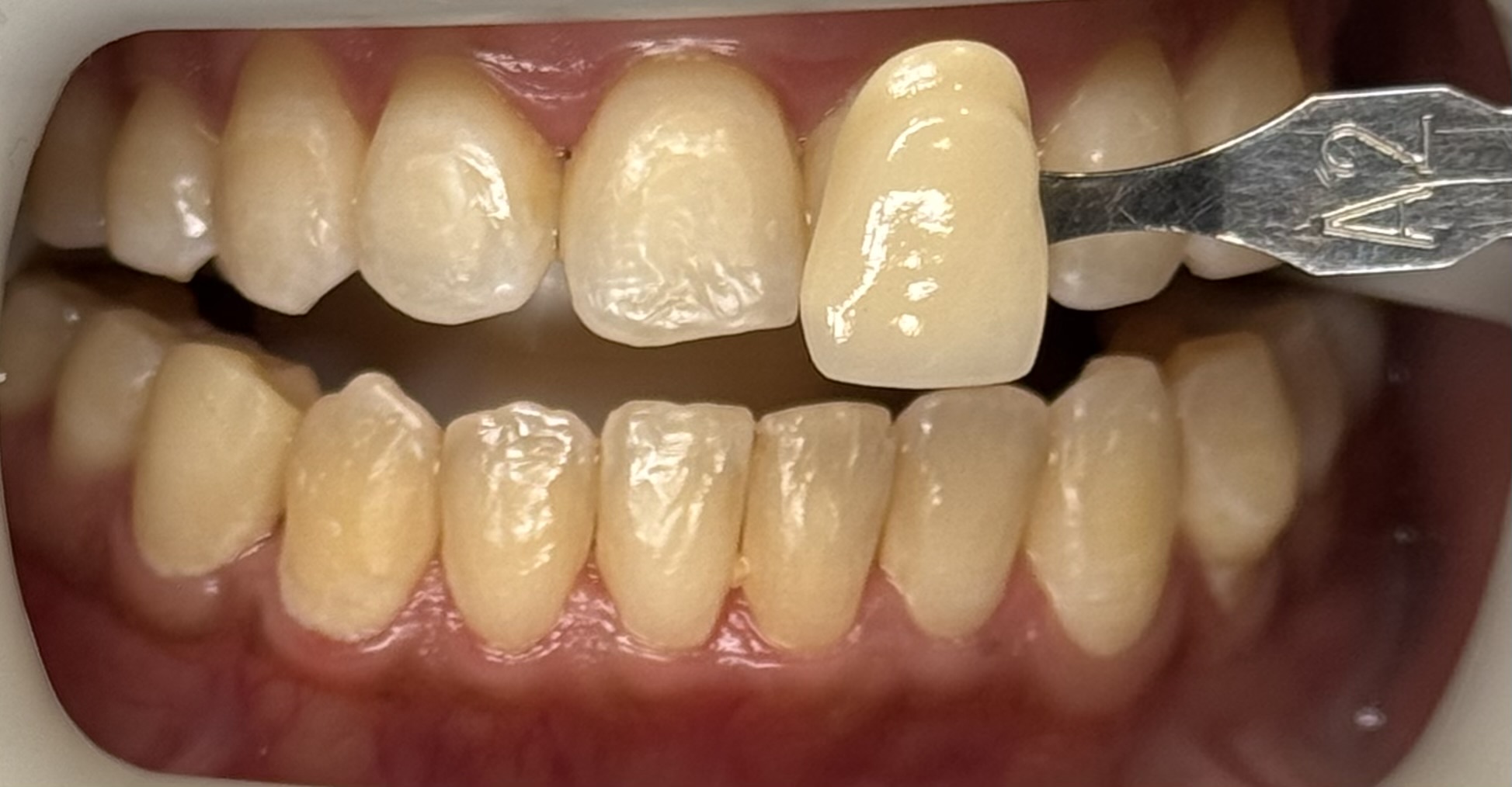 Teeth Whitening, case 1 — before treatment