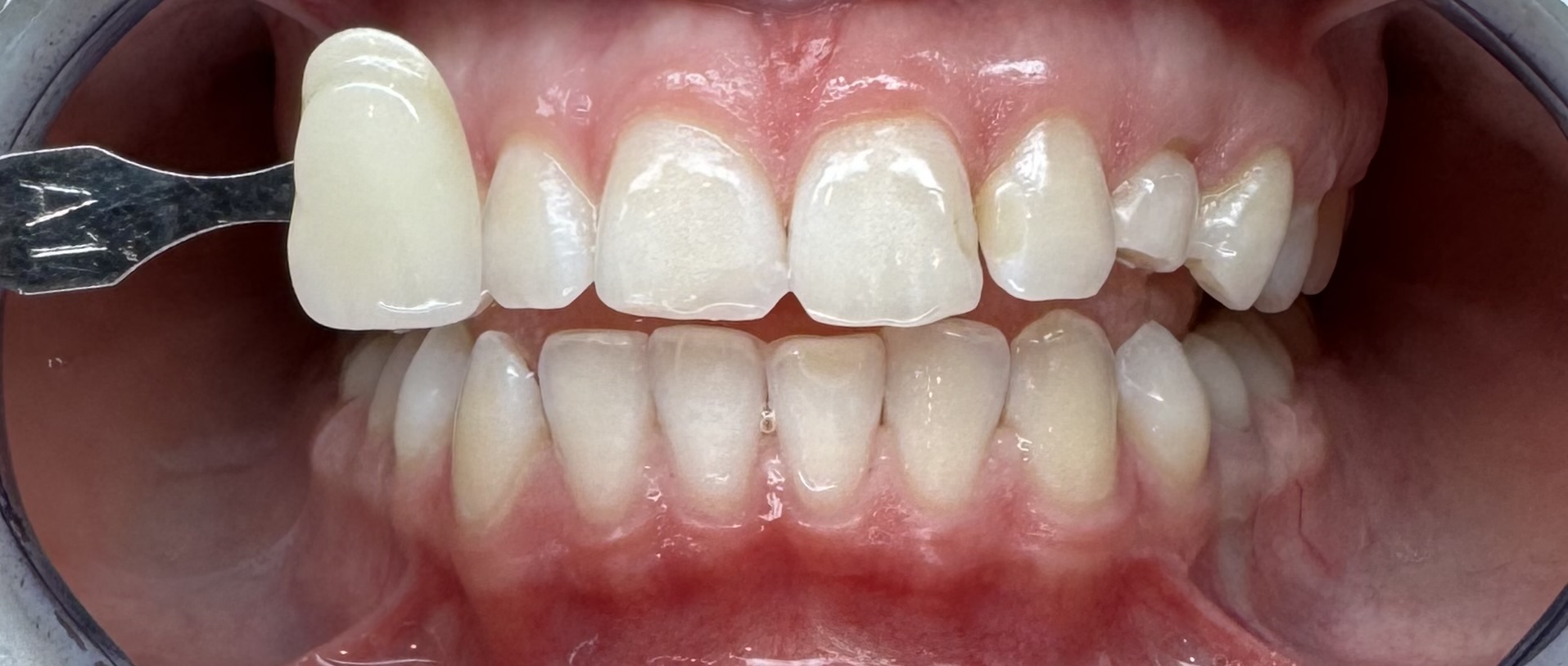 Teeth Whitening, case 2 — after treatment