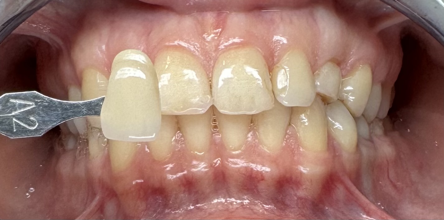 Teeth Whitening, case 2 — before treatment
