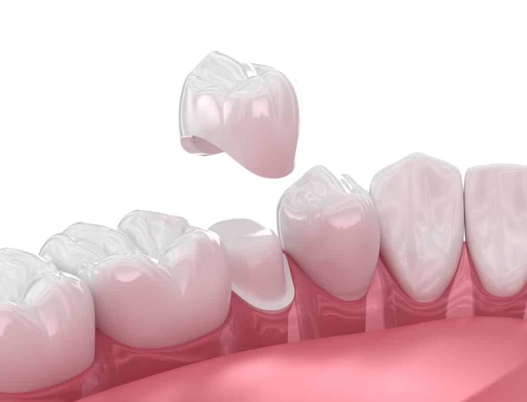 Dental Crowns Near Me in Hoffman Estates