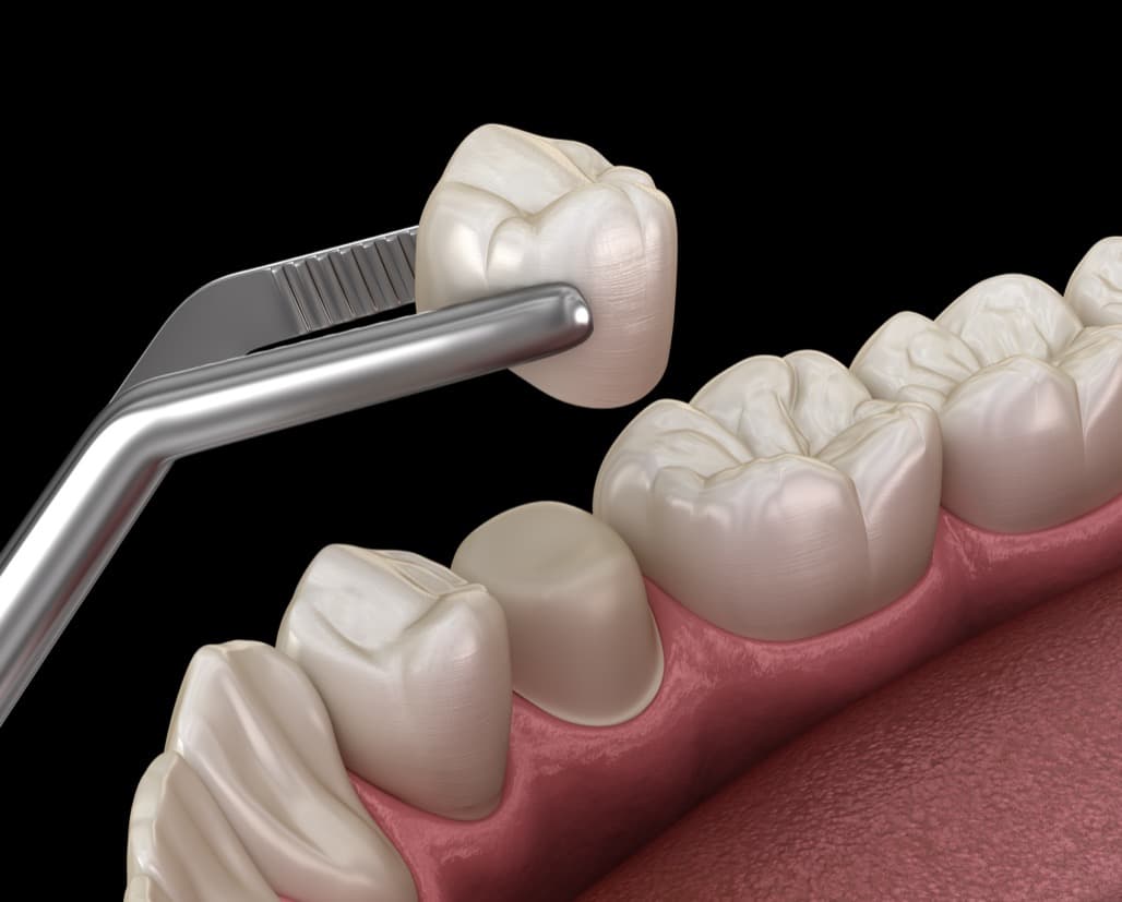 Dental Crowns Near Me in Hoffman Estates