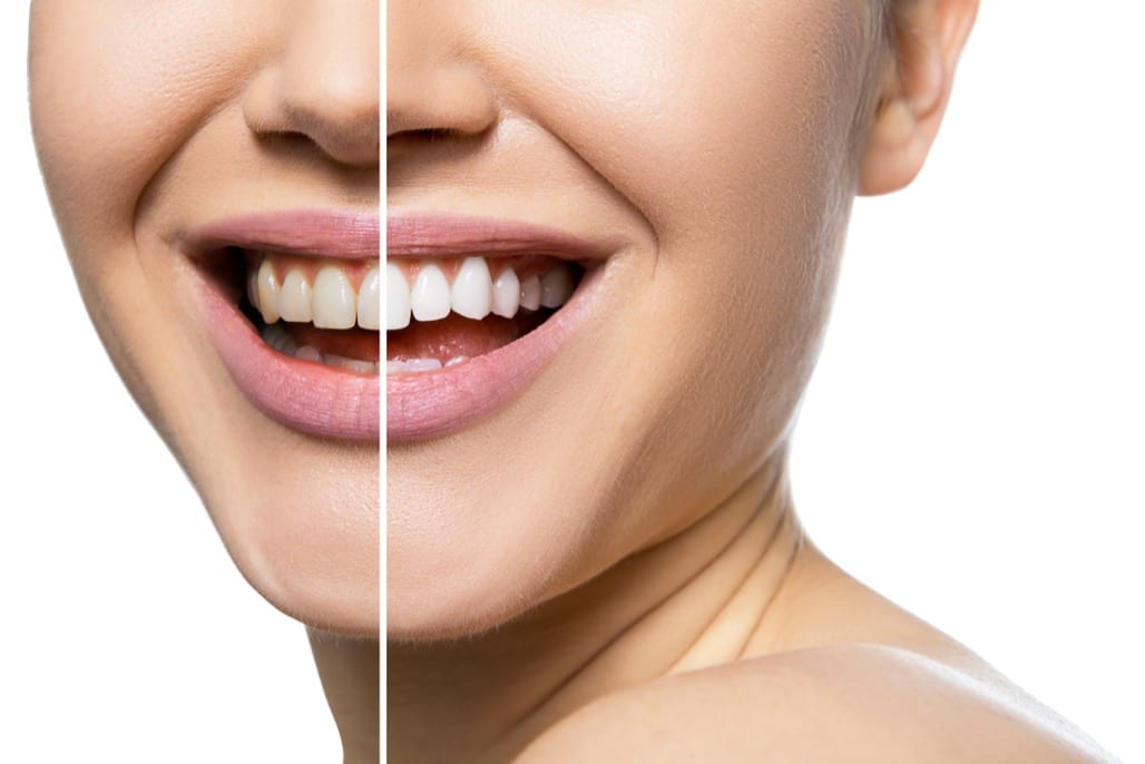 Teeth Whitening Treatment in Hoffman Estates