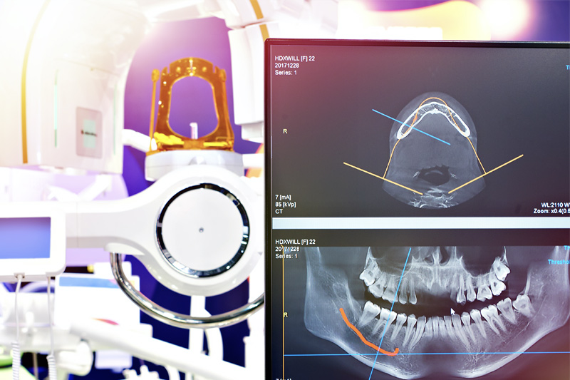 Digital X-ray screen showing a panoramic scan of a patient’s teeth