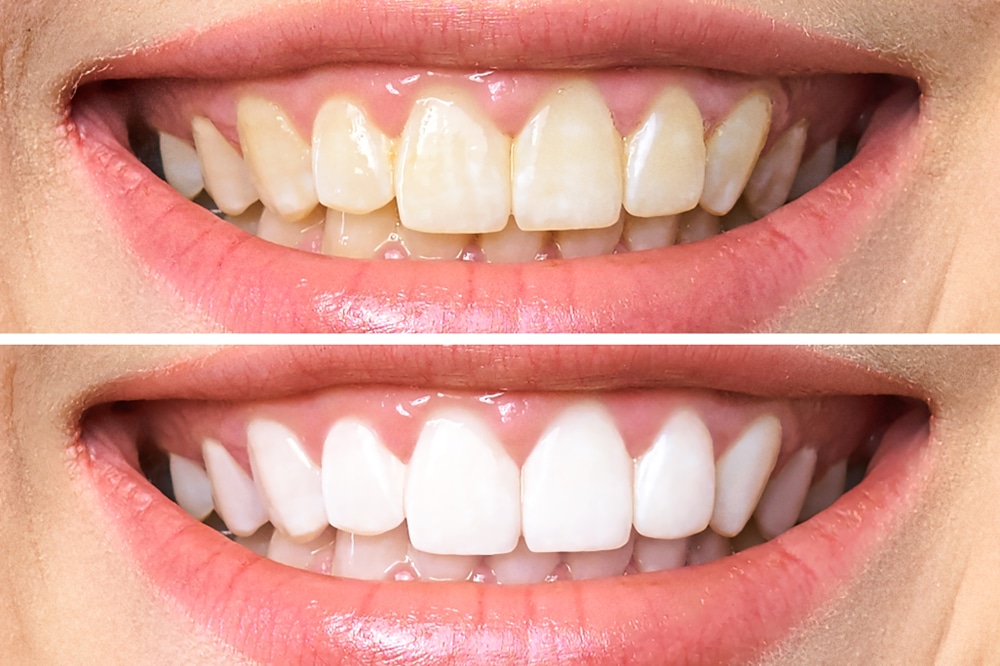 Common Questions: Teeth Whitening Treatment Near Me, Hoffman Estates IL